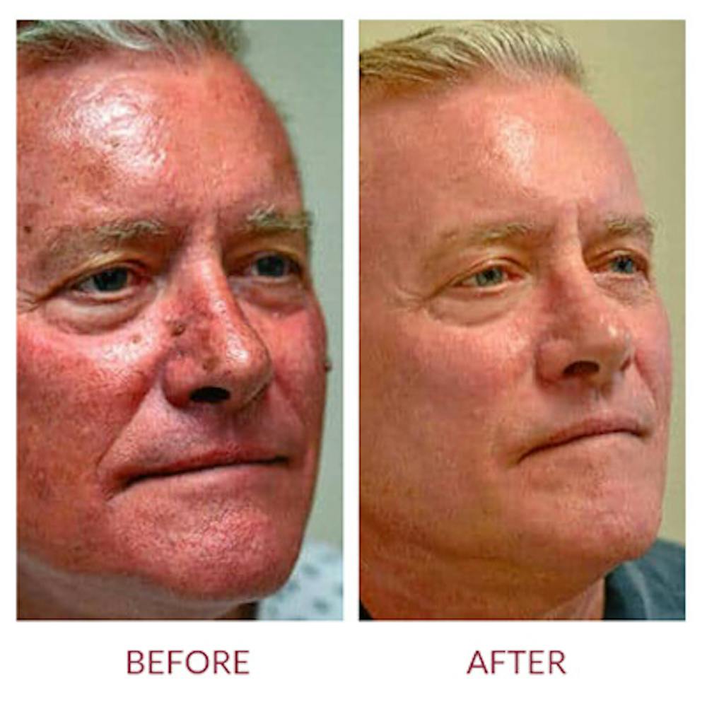 Co2 Laser Resurfacing Before & After Gallery - Patient 26868808 - Image 1
