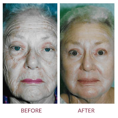 Co2 Laser Resurfacing Before & After Gallery - Patient 26868807 - Image 1