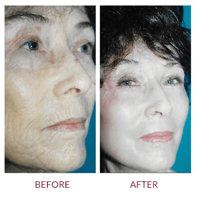 Co2 Laser Resurfacing Before & After Gallery - Patient 26868806 - Image 1