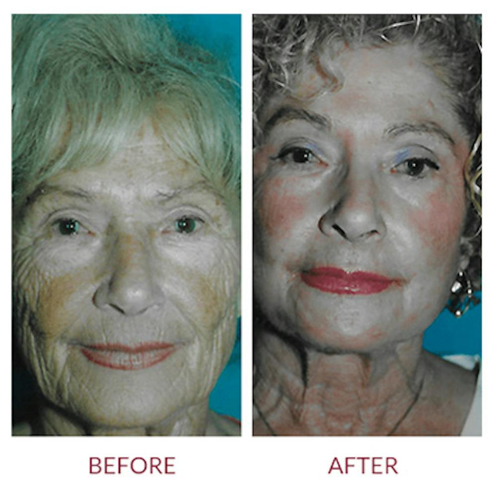Co2 Laser Resurfacing Before & After Gallery - Patient 26868805 - Image 1