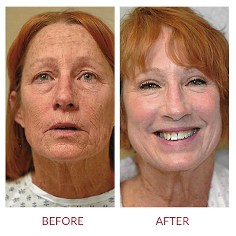 Co2 Laser Resurfacing Before & After Gallery - Patient 26868804 - Image 1