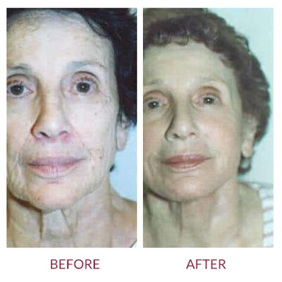 Ear Surgery Before & After Gallery - Patient 26868828 - Image 1