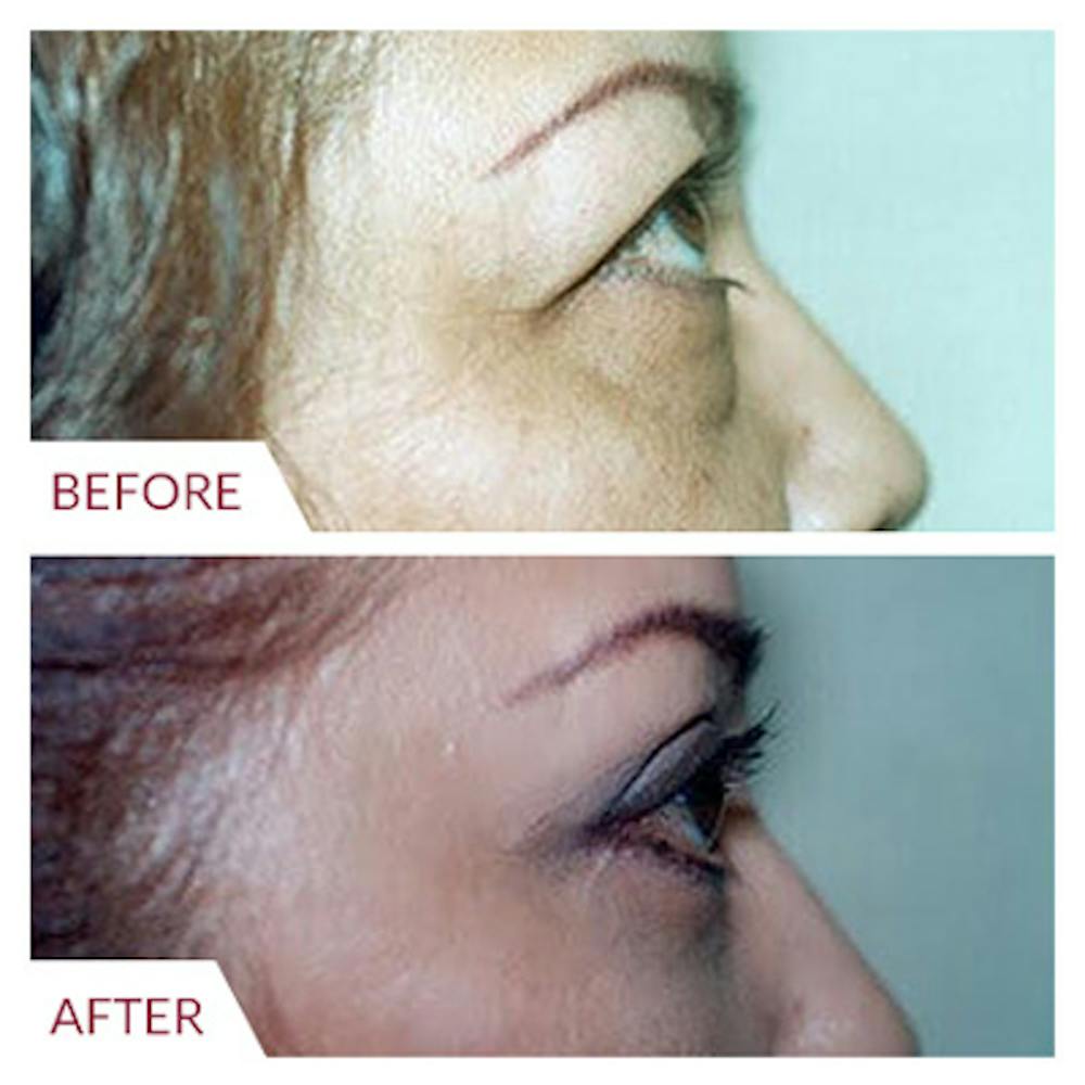 Eyelid Surgery Gallery - Patient 26868838 - Image 4