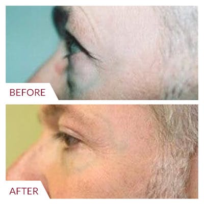 Eyelid Surgery Before & After Gallery - Patient 26868841 - Image 1