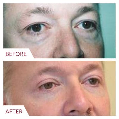 Eyelid Surgery Before & After Gallery - Patient 26868840 - Image 2