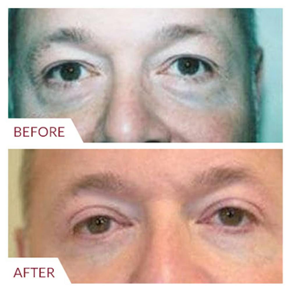 Eyelid Surgery Gallery - Patient 26868840 - Image 1