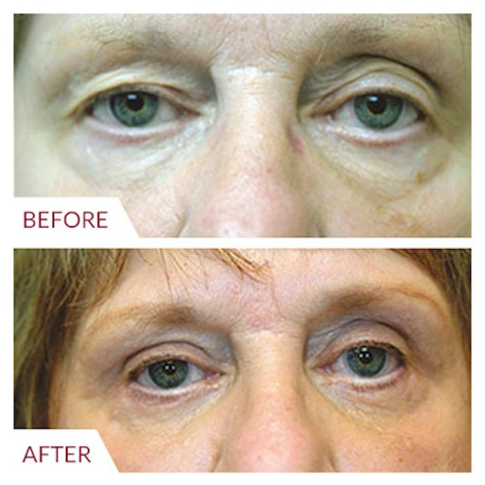 Eyelid Surgery Before & After Gallery - Patient 26868839 - Image 1