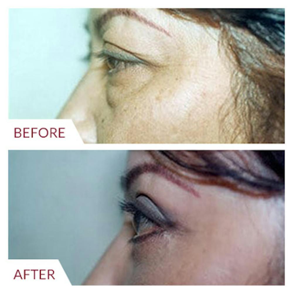 Eyelid Surgery Before & After Gallery - Patient 26868838 - Image 3