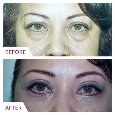 Eyelid Surgery Before & After Gallery - Patient 26868838 - Image 2