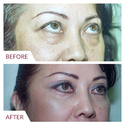 Eyelid Surgery Before & After Gallery - Patient 26868838 - Image 1