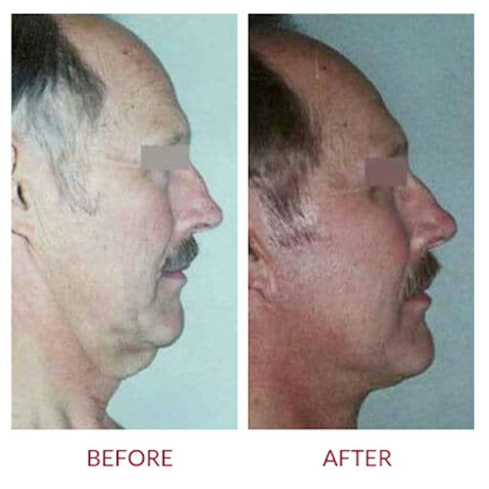 Facelift Before & After Gallery - Patient 26870267 - Image 2