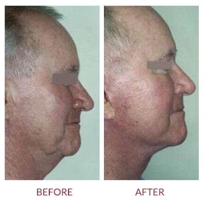 Facelift Before & After Gallery - Patient 26870268 - Image 1