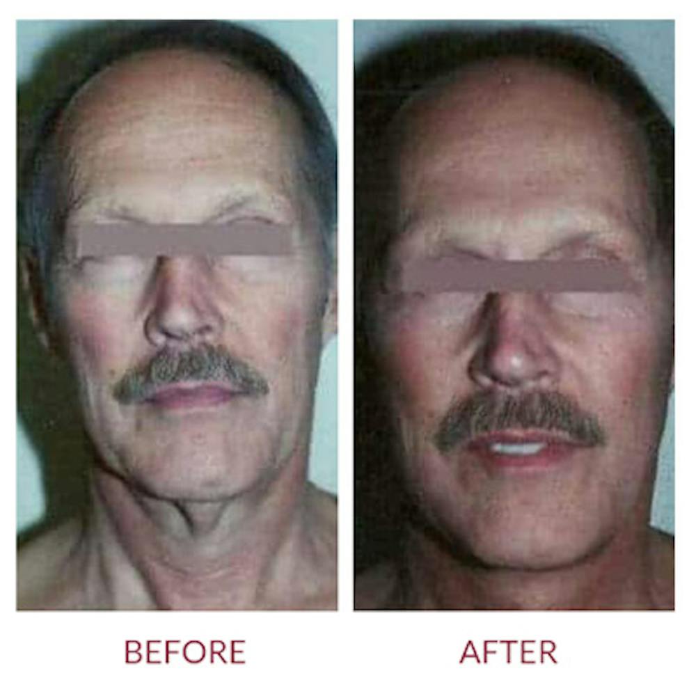 Facelift Before & After Gallery - Patient 26870267 - Image 1
