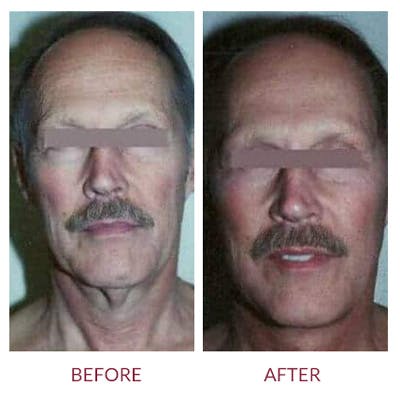 Facelift Before & After Gallery - Patient 26870267 - Image 1