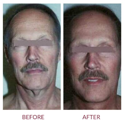 Facelift Before & After Gallery - Patient 26870267 - Image 1