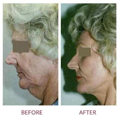 Facelift Before & After Gallery - Patient 26870266 - Image 1