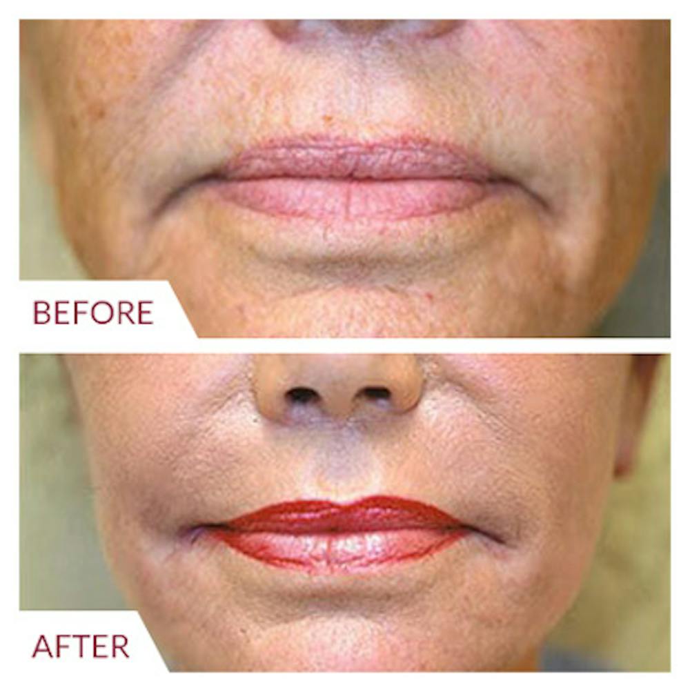 Facelift Before & After Gallery - Patient 26870265 - Image 5