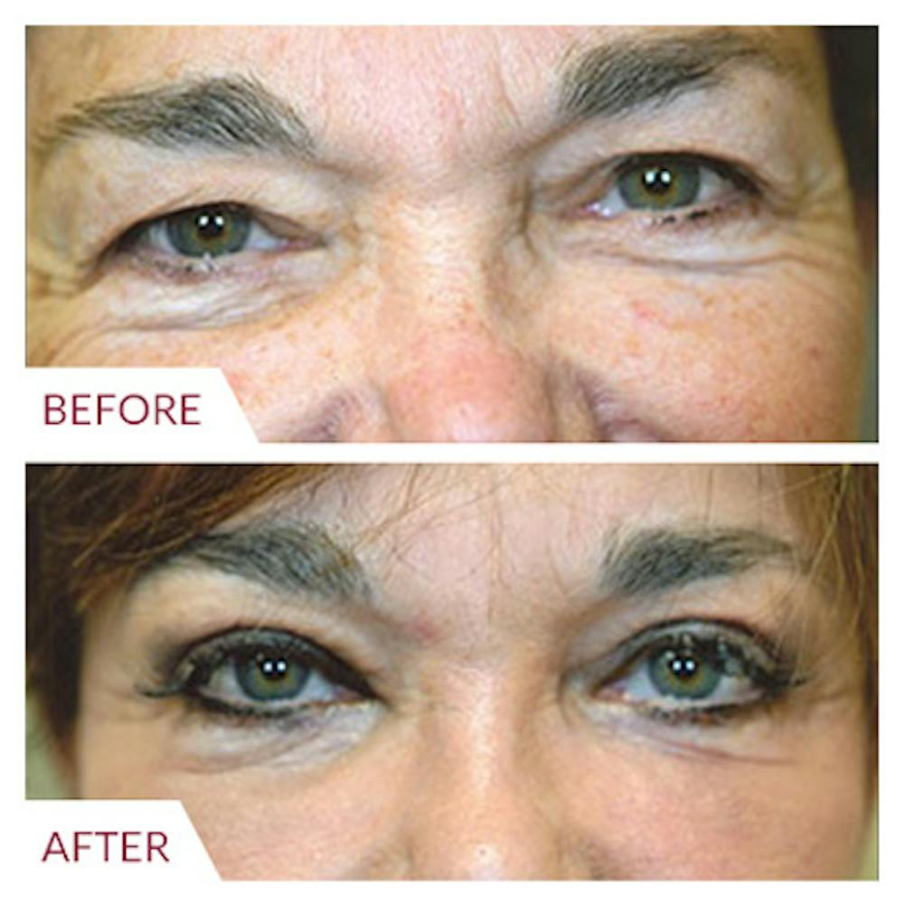 Facelift Before & After Gallery - Patient 26870265 - Image 4