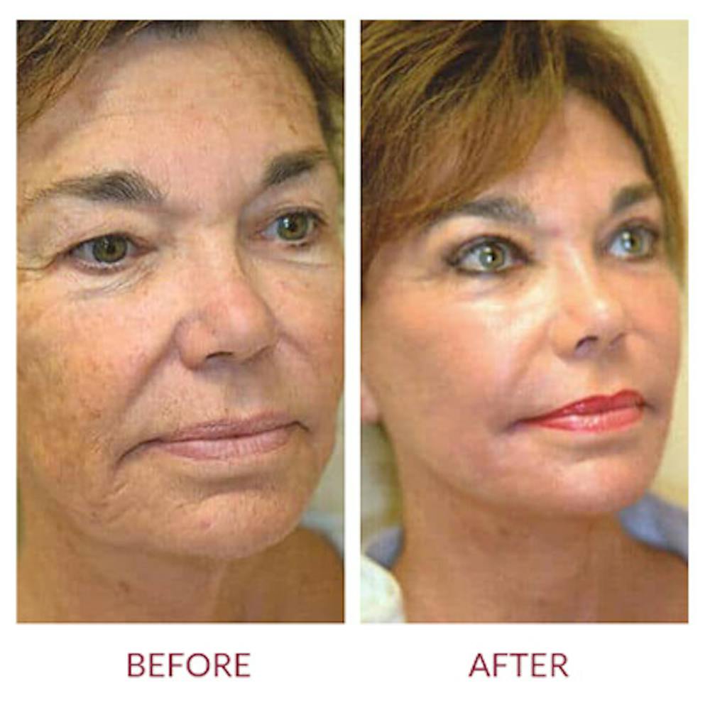 Facelift Before & After Gallery - Patient 26870265 - Image 3