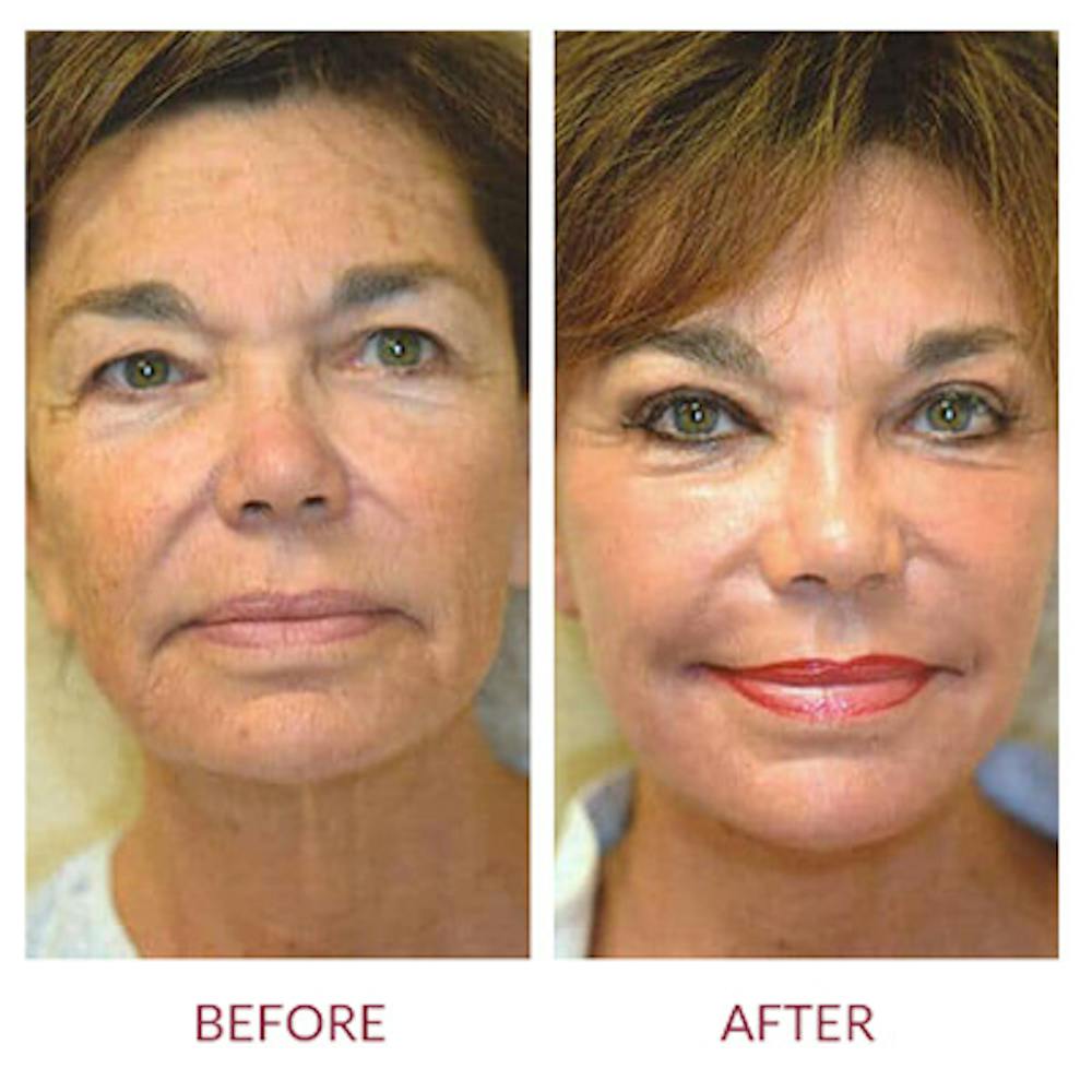 Facelift Before & After Gallery - Patient 26870265 - Image 2