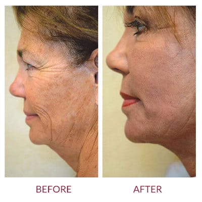 Facelift Before & After Gallery - Patient 26870265 - Image 1