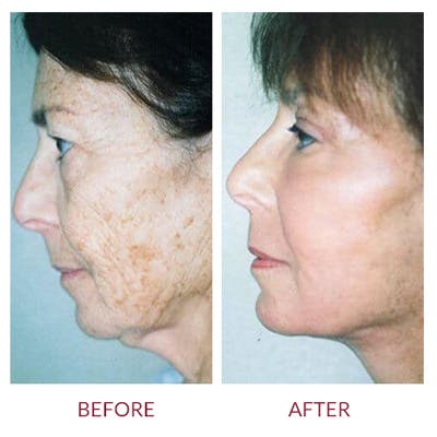 Facelift Before & After Gallery - Patient 26870264 - Image 1