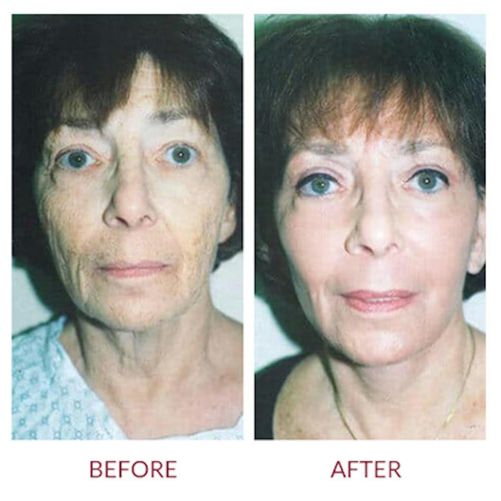 Facelift Before & After Gallery - Patient 26870263 - Image 1