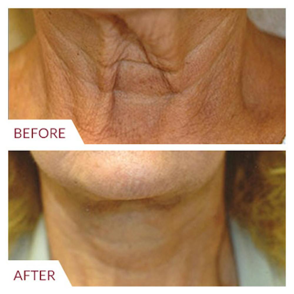 Facelift Before & After Gallery - Patient 26870262 - Image 1