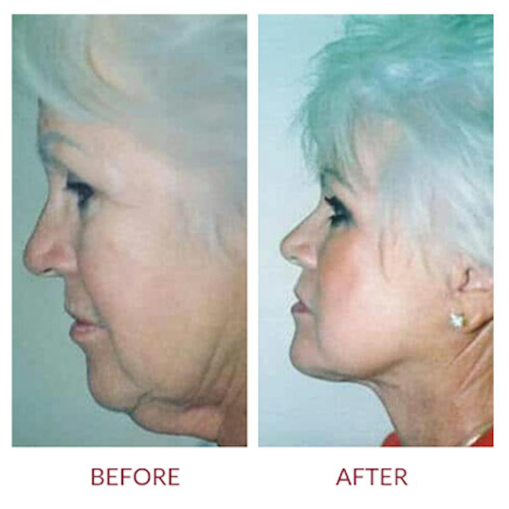 Facelift Before & After Gallery - Patient 26870261 - Image 3