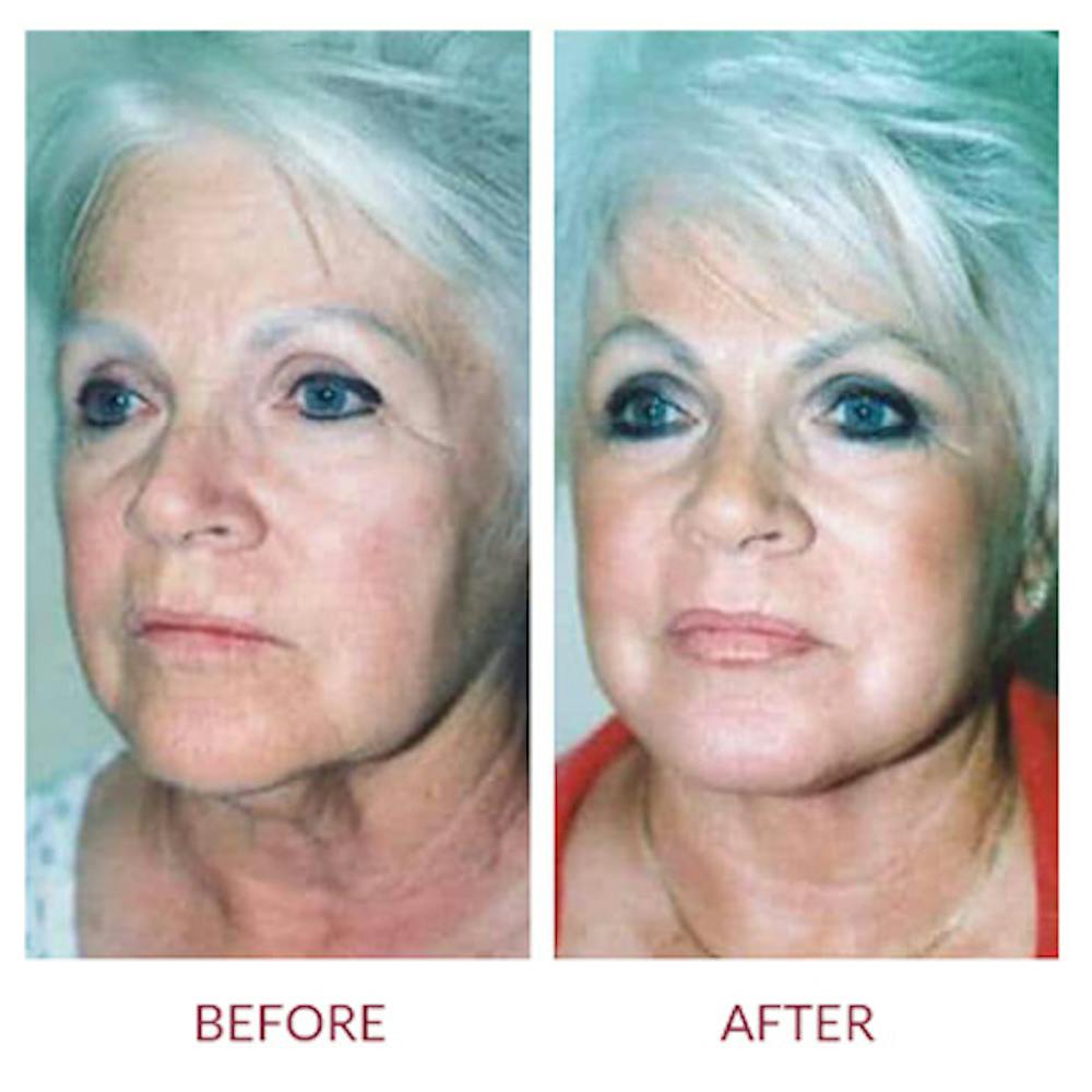 Facelift Before & After Gallery - Patient 26870261 - Image 2
