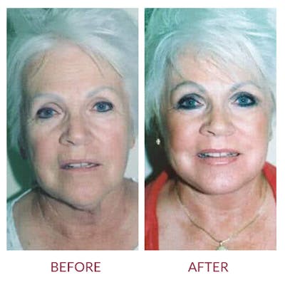 Facelift Before & After Gallery - Patient 26870261 - Image 1