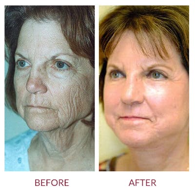 Facelift Before & After Gallery - Patient 26870260 - Image 1