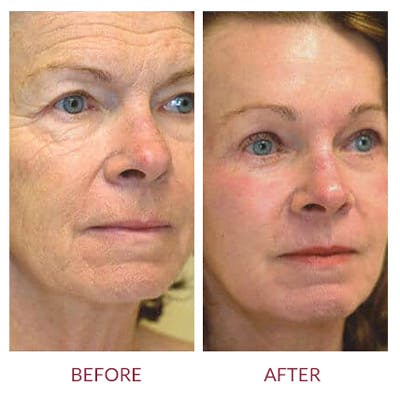 Facelift Before & After Gallery - Patient 26870259 - Image 4