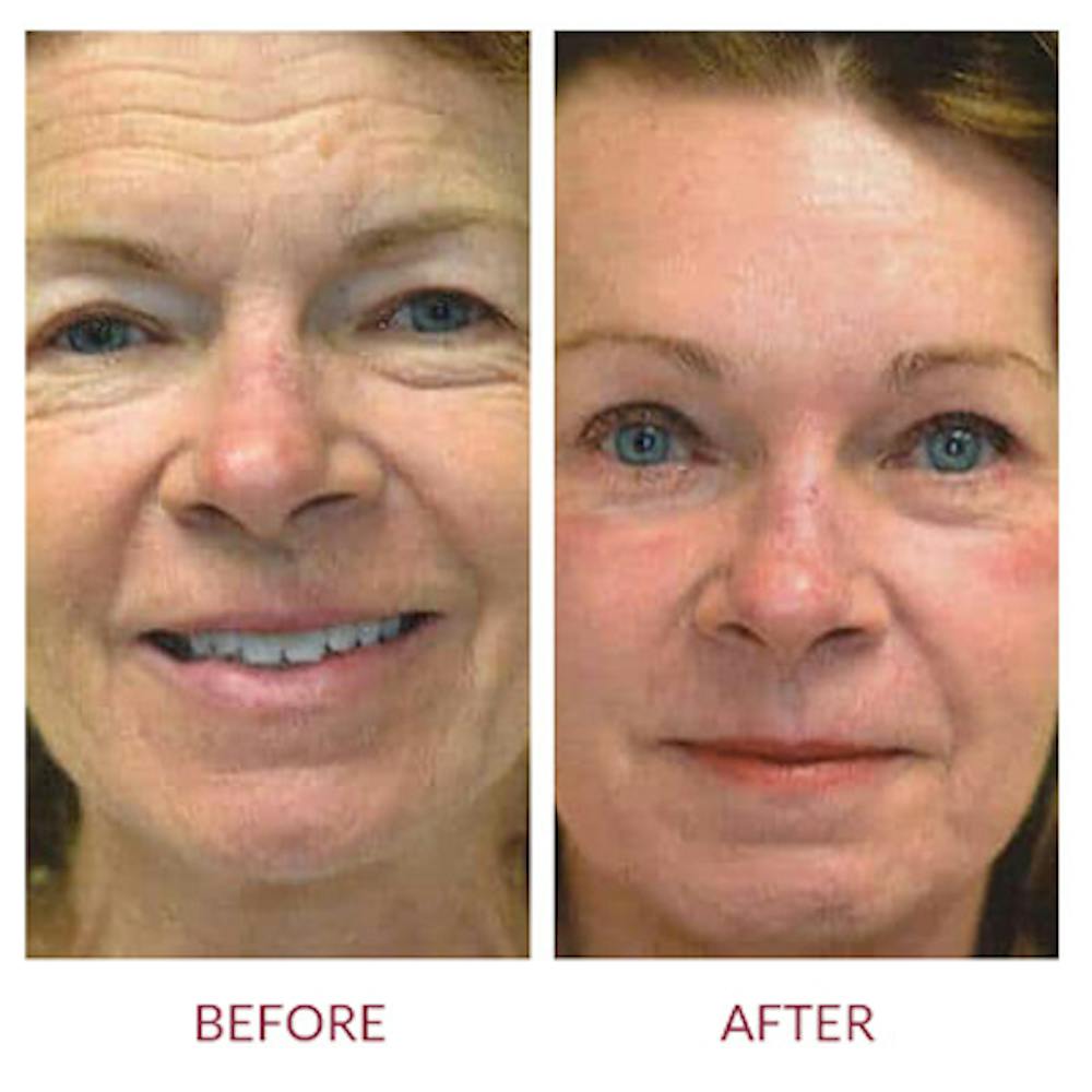 Facelift Before & After Gallery - Patient 26870259 - Image 3