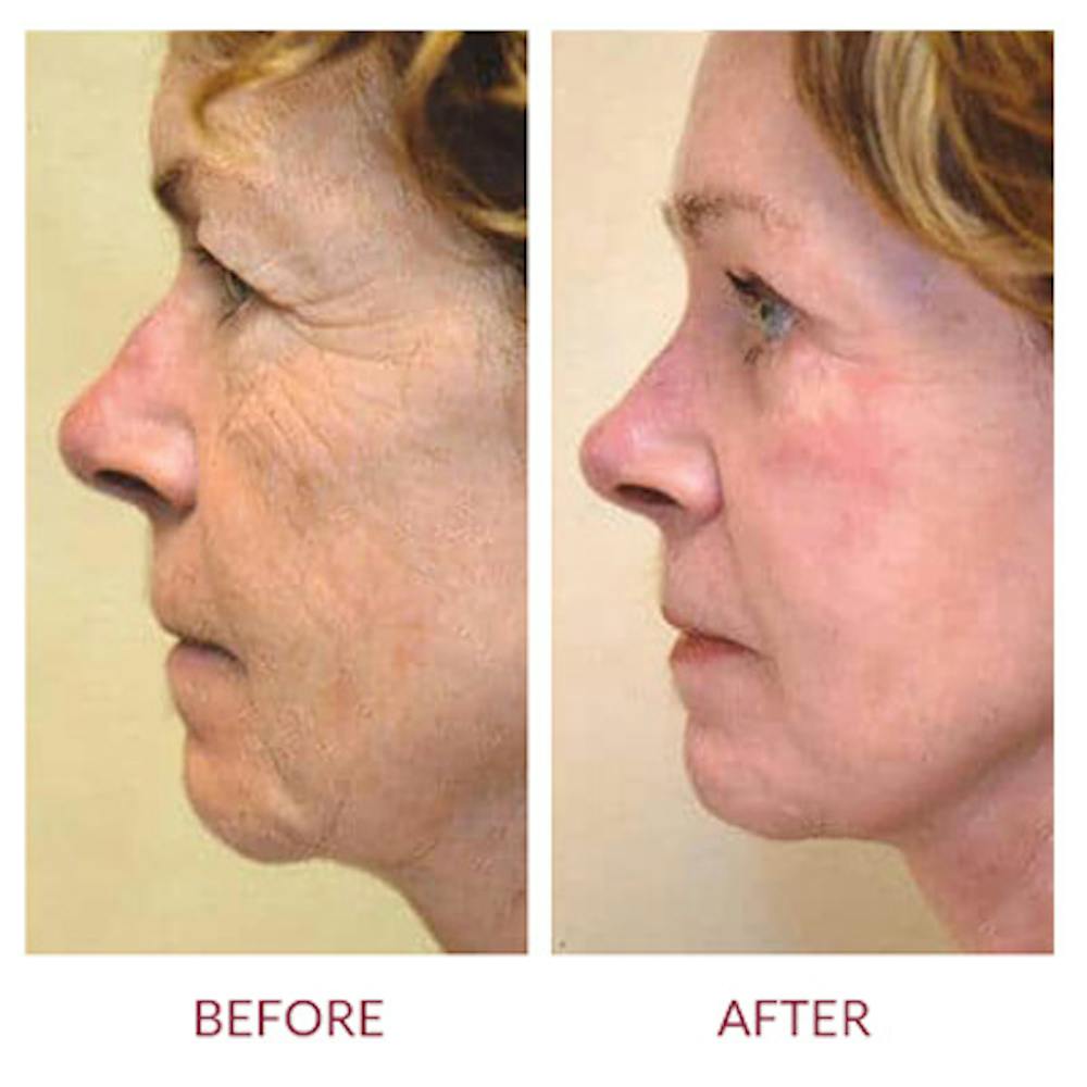 Facelift Before & After Gallery - Patient 26870259 - Image 2