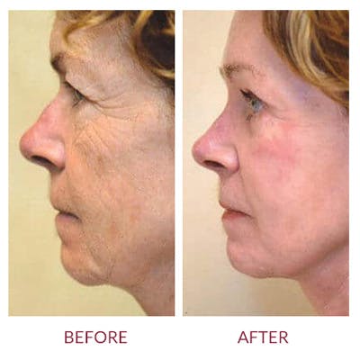 Facelift Before & After Gallery - Patient 26870259 - Image 2