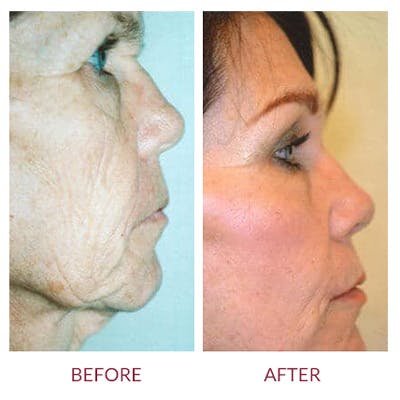 Facelift Before & After Gallery - Patient 26870259 - Image 1