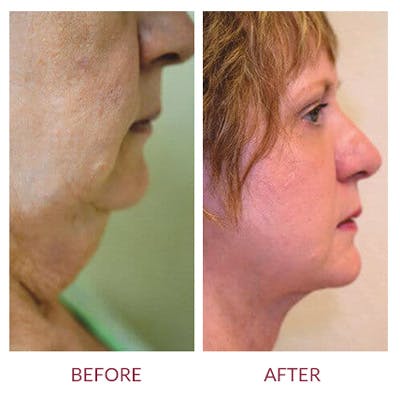 Facelift Before & After Gallery - Patient 26870258 - Image 2