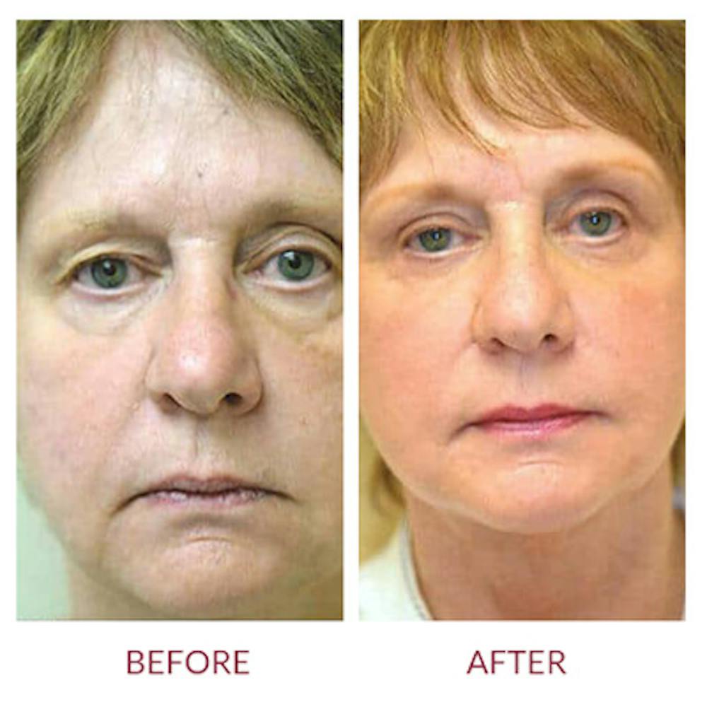Facelift