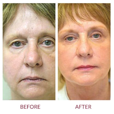 Facelift Before & After Gallery - Patient 26870258 - Image 1