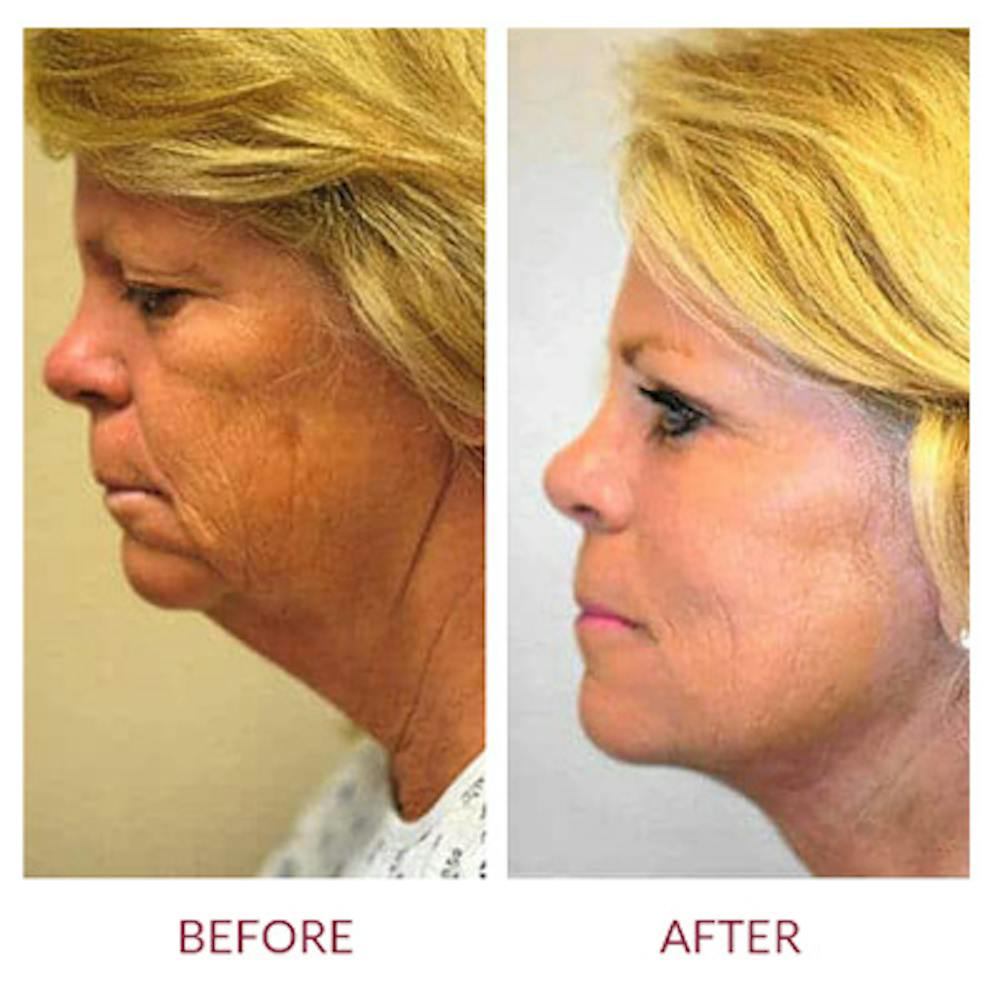 Facelift Before & After Gallery - Patient 26870257 - Image 2