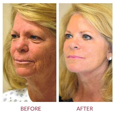 Facelift Before & After Gallery - Patient 26870257 - Image 1