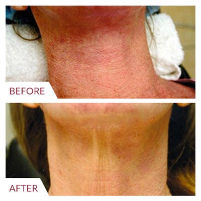 Pixel Before & After Gallery - Patient 26870290 - Image 1