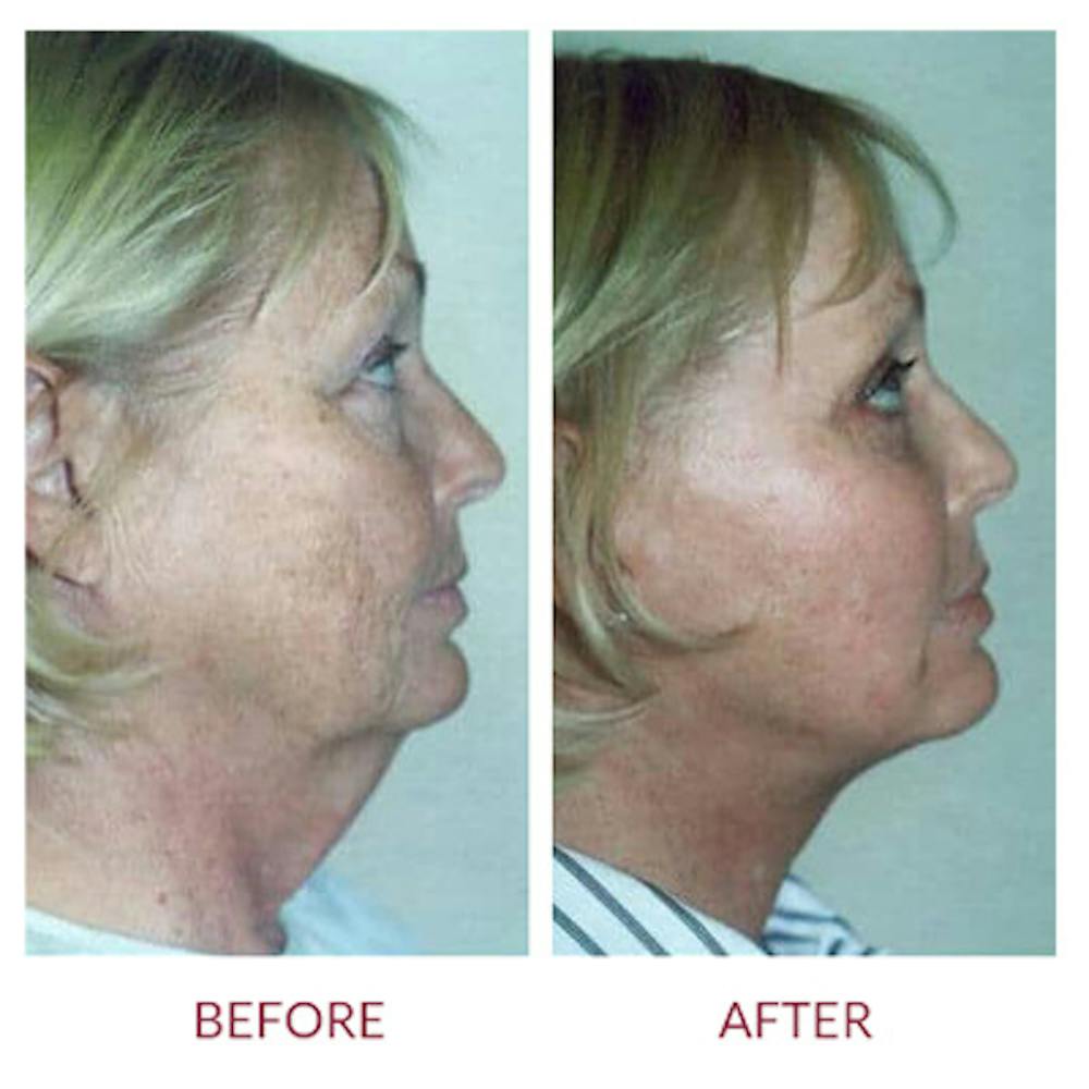 Neck Lift Before & After Gallery - Patient 26870288 - Image 2
