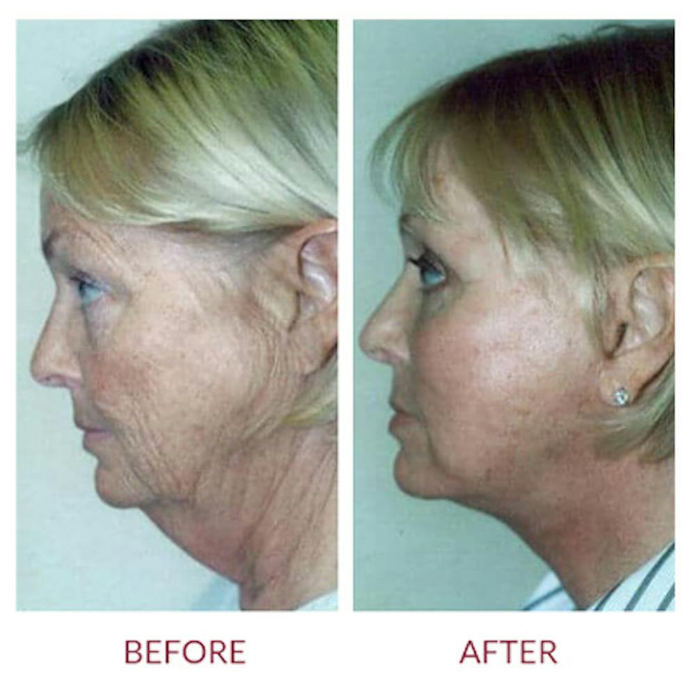 Neck Lift Before & After Gallery - Patient 26870288 - Image 1