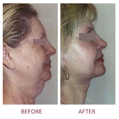 Neck Lift Before & After Gallery - Patient 26870287 - Image 1