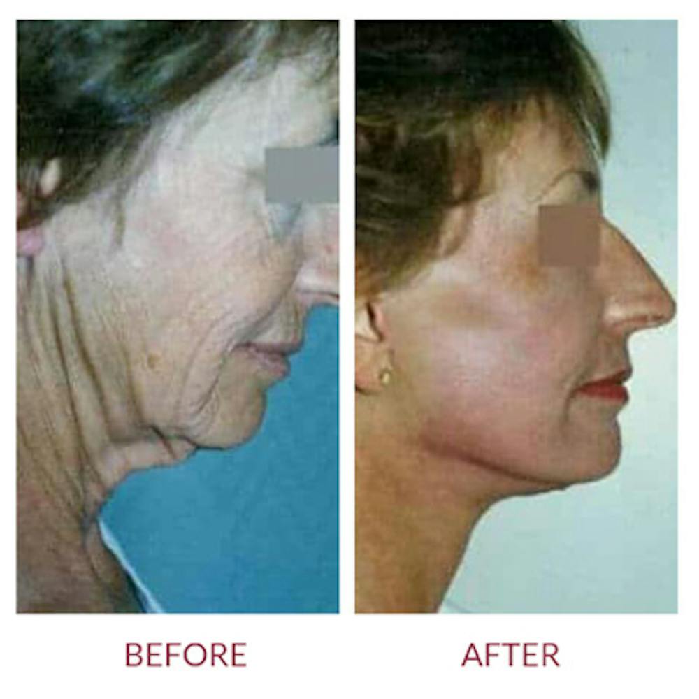 Neck Lift Before & After Gallery - Patient 26870286 - Image 1