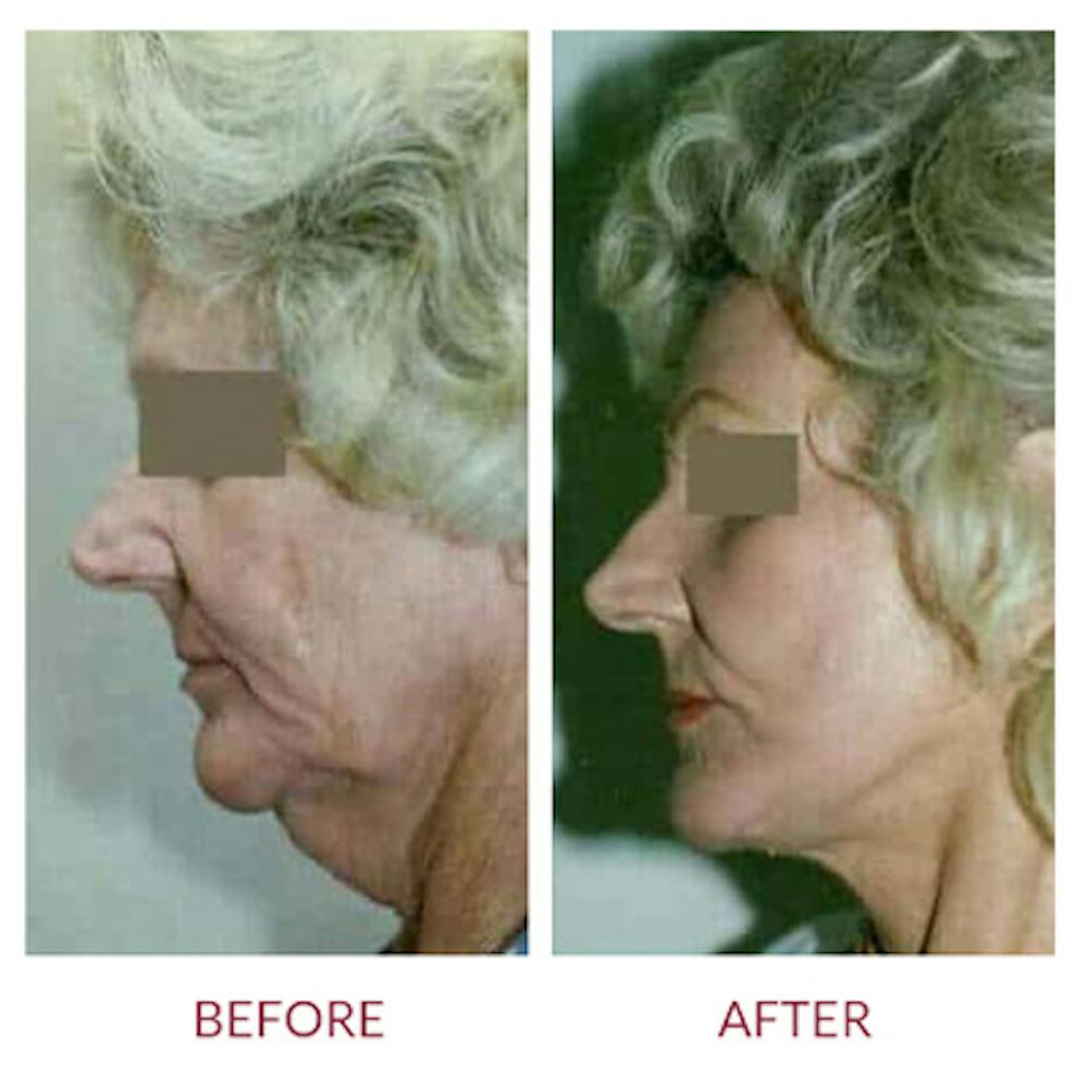 Neck Lift Before & After Gallery - Patient 26870283 - Image 1