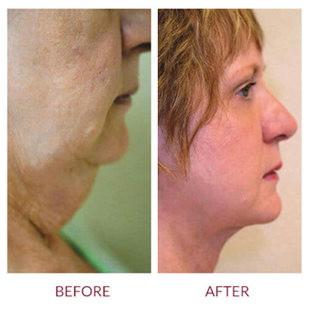 Neck Lift