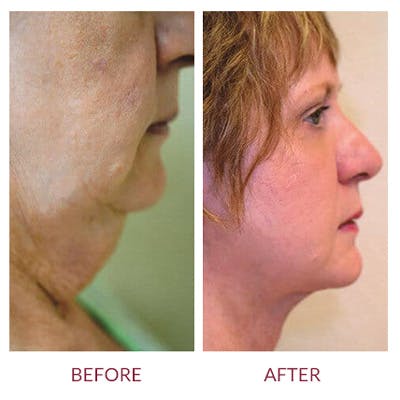 Neck Lift Before & After Gallery - Patient 26870282 - Image 1